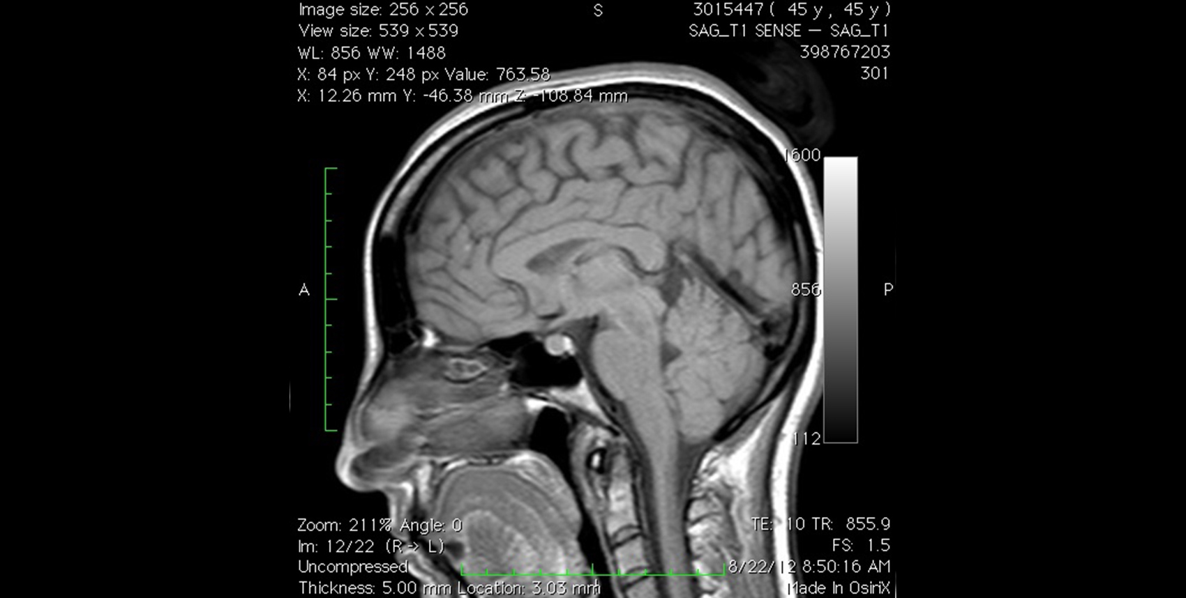 Chiari Treatment