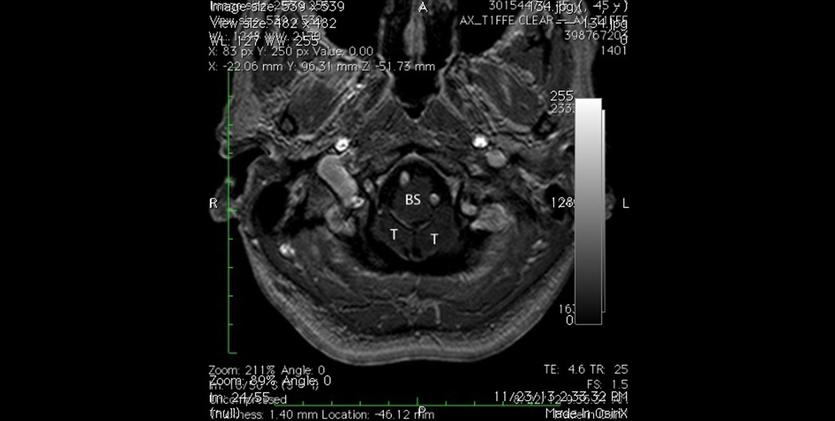 Bringing relief to those suffering from Chiari Malformation