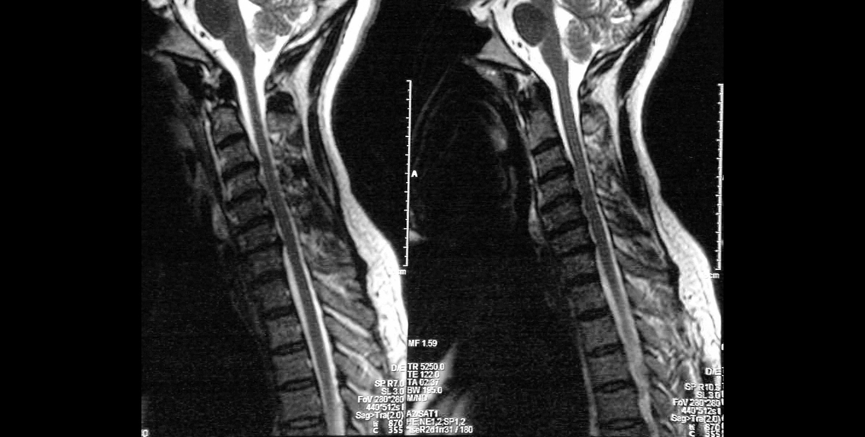 Cervical Spinal Stenosis