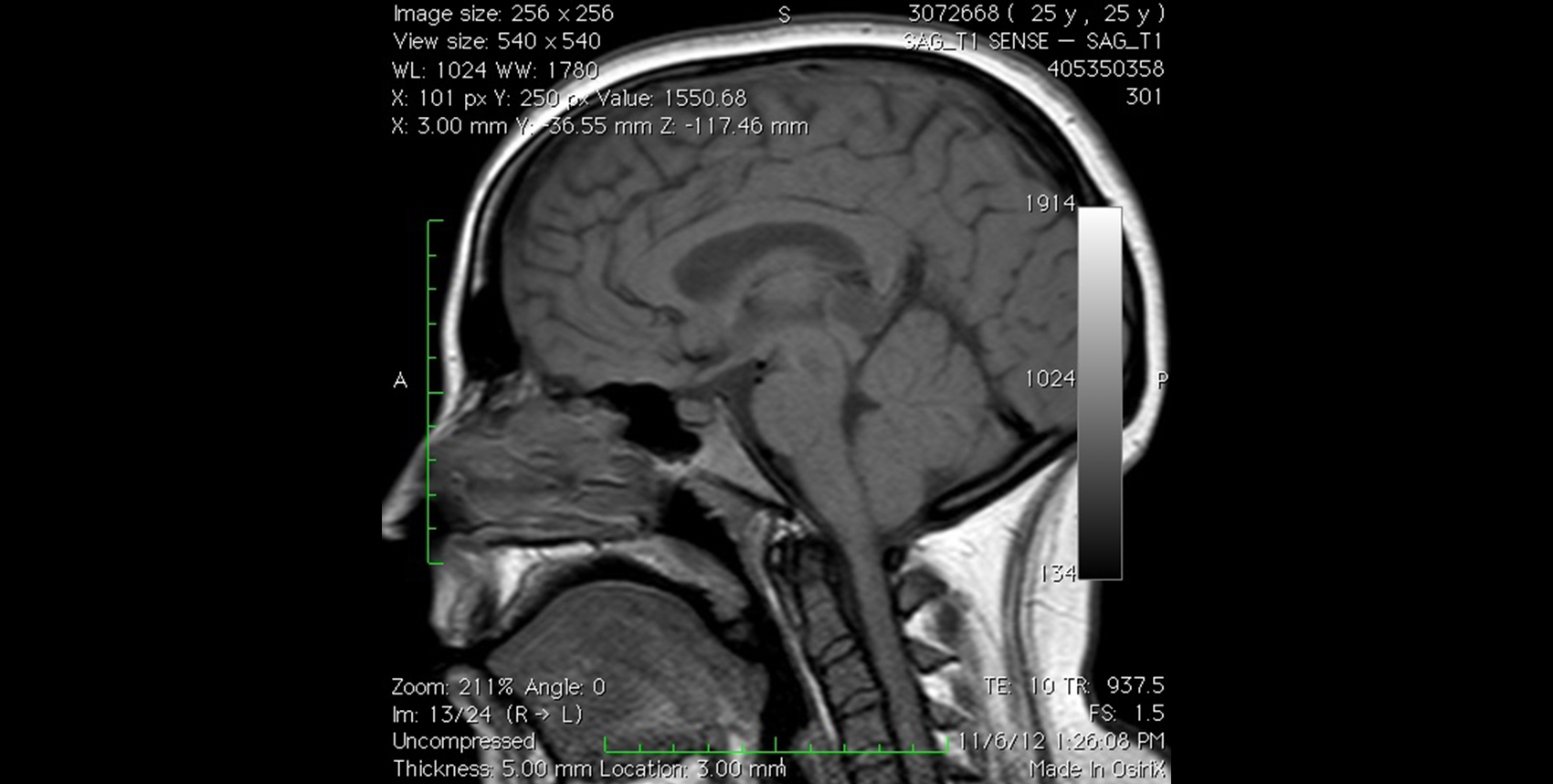 Chiari Malformation Signs & Symptoms