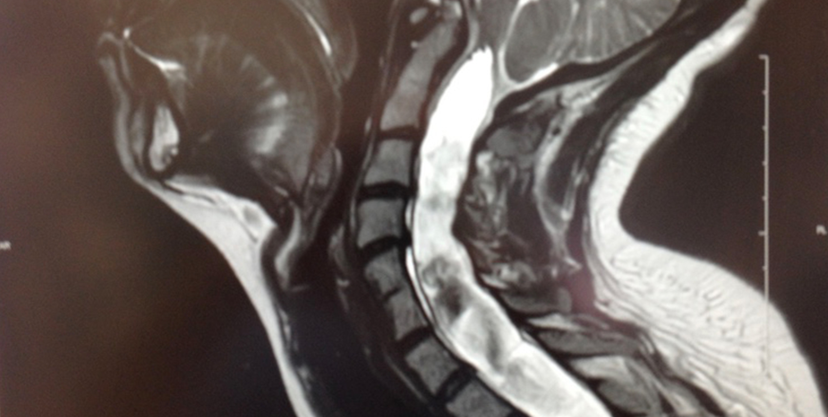 Syringomyelia