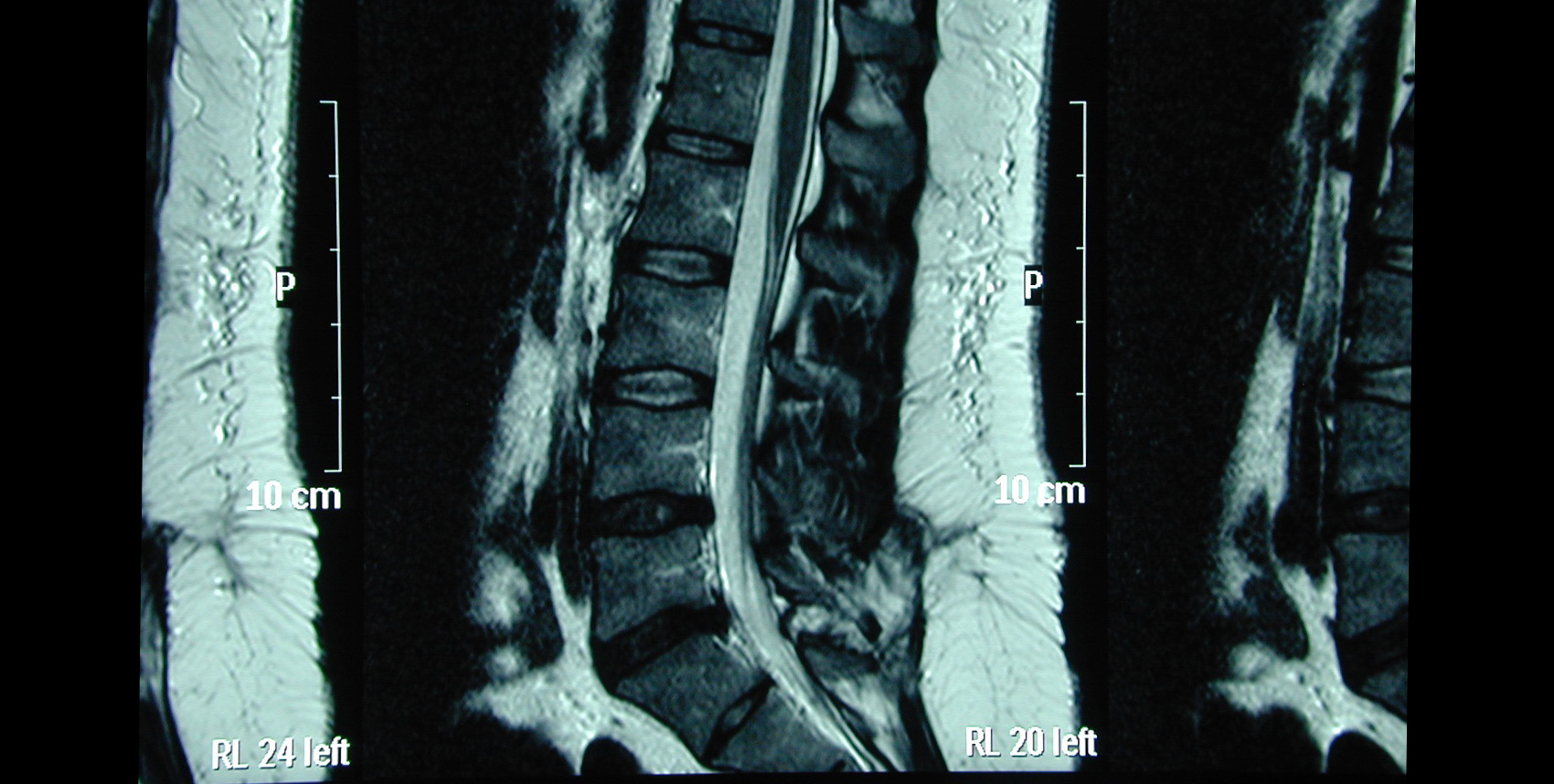 Tethered Cord Syndrome