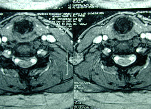 Cervical Stenosis