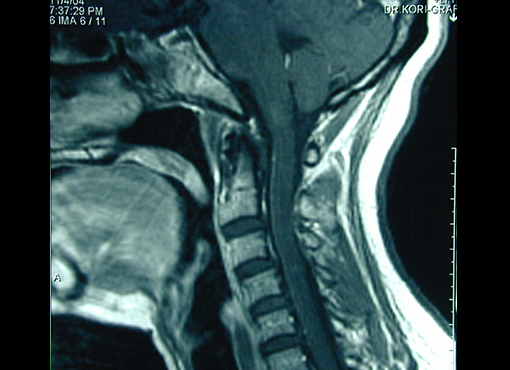 MRI-Scan - Cervical Spinal Stenosis