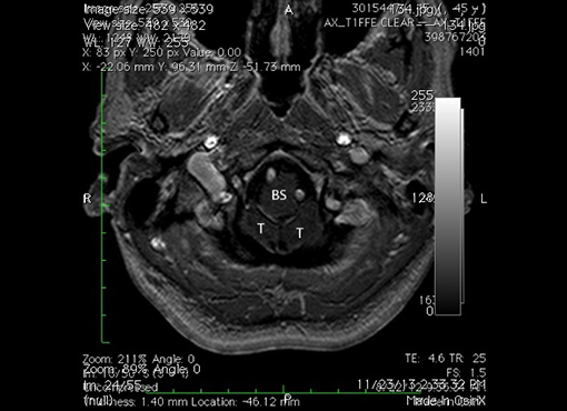 MRI of the brain- axial section-showing the crowding of the structures within the foramen magnum. T= tonsil. BS = brain stem.