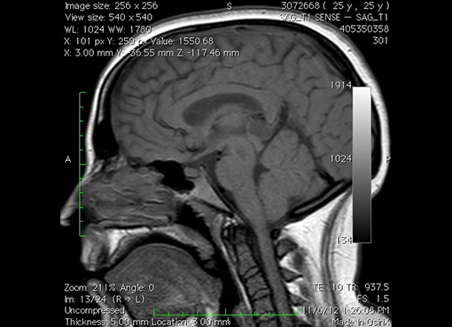 MRI Image