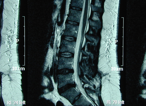 MRI of TCS