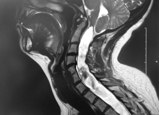 Syringomyelia