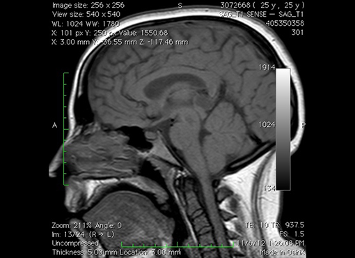 Chiari Signs and Symptoms